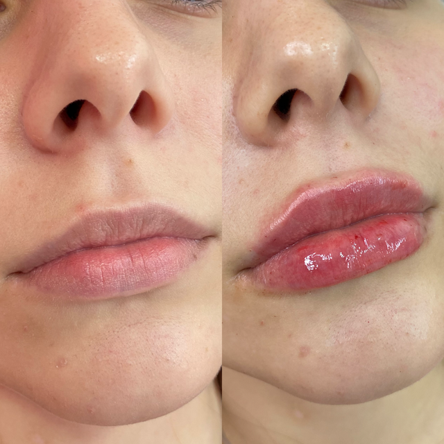 Preenchimento labial em Jundiapeba Mogi das Cruzes